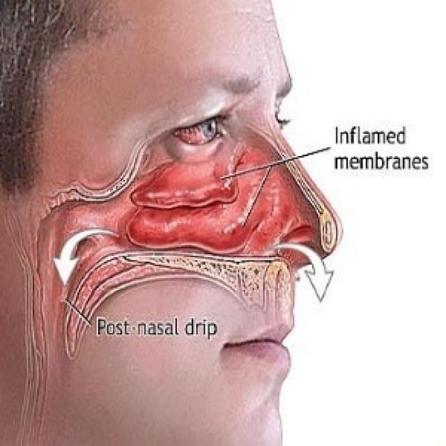 Top Natural Remedies For Sinus Congestion You Can Make At Home