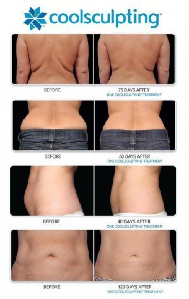 health-and-beauty-how-much-does-coolsculpting-cost-2365090-weddbook