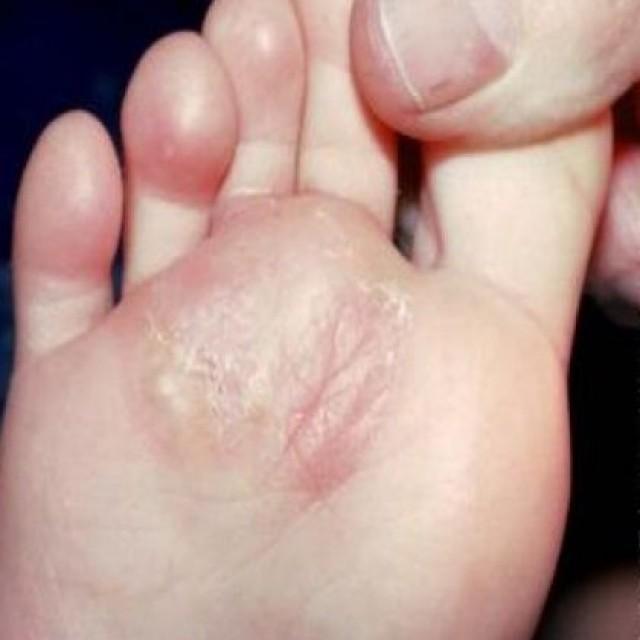 What Herbs Are Good For Foot Fungus