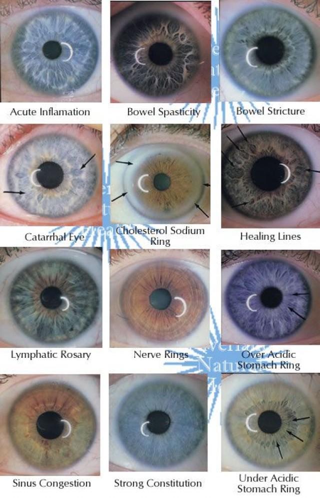 Health And Beauty Examples Of Main Iris Markings/Rings 2498090